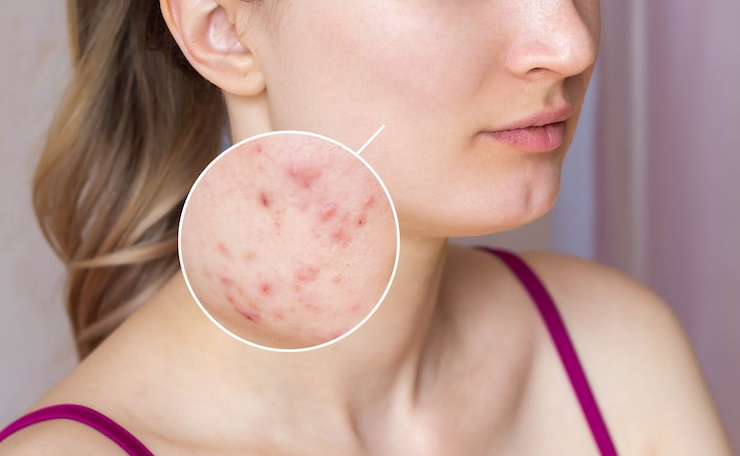 Acne Scars Treatment in Bhopal